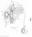 Fig. 02 - Electroosmotic tissue treatment