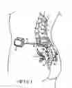 Fig. 02 - MINIMALLY INVASIVE METHODS FOR IMPLANTING A SACRAL STIMULATION LEAD