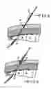 Fig. 07 - MINIMALLY INVASIVE METHODS FOR IMPLANTING A SACRAL STIMULATION LEAD