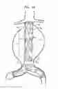 Fig. 02 - Stent-grafts with post-deployment variable radial displacement
