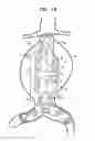 Fig. 03 - Stent-grafts with post-deployment variable radial displacement