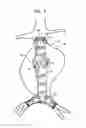 Fig. 09 - Stent-grafts with post-deployment variable radial displacement