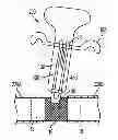 Fig. 01 - Blood perfusion device delivery system