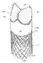 Fig. 01 - Low-profile heart valve and delivery system