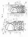 Fig. 02 - Low-profile heart valve and delivery system