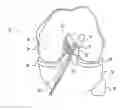 Fig. 01 - Method for creating a double bundle ligament orientation in a single bone tunnel during knee ligament reconstruction