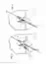 Fig. 03 - Method for creating a double bundle ligament orientation in a single bone tunnel during knee ligament reconstruction