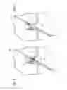 Fig. 04 - Method for creating a double bundle ligament orientation in a single bone tunnel during knee ligament reconstruction