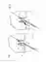 Fig. 05 - Method for creating a double bundle ligament orientation in a single bone tunnel during knee ligament reconstruction