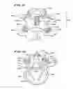 Fig. 06 - Facet arthroplasty devices and methods