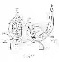 Fig. 04 - Constrained knee prosthesis