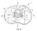Fig. 09 - Constrained knee prosthesis