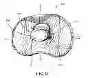 Fig. 10 - Constrained knee prosthesis