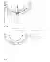 Fig. 03 - PROSTHETIC ACETABULAR CUP