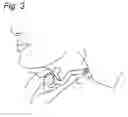 Fig. 03 - AUTOMATIC TRACHEOSTOMA SPEECH VALVE (ASTV) FIXATION BRACE