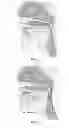 Fig. 02 - Mandibular repositioning device