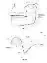 Fig. 07 - Mandibular repositioning device