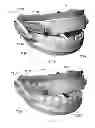 Fig. 12 - Mandibular repositioning device