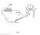 Fig. 02 - Diathermy knife ionisation source