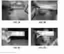 Fig. 03 - PRODUCT AND METHOD FOR TREATING KELOID SCARS, HYPERTROPHIC SCARS AND BURN SCARS WITH CONTRACTURE