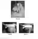 Fig. 04 - PRODUCT AND METHOD FOR TREATING KELOID SCARS, HYPERTROPHIC SCARS AND BURN SCARS WITH CONTRACTURE