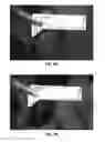 Fig. 06 - PRODUCT AND METHOD FOR TREATING KELOID SCARS, HYPERTROPHIC SCARS AND BURN SCARS WITH CONTRACTURE
