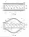 Fig. 16 - DRUG DELIVERY METHODS, STRUCTURES, AND COMPOSITIONS FOR NASOLACRIMAL SYSTEM