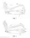 Fig. 02 - Progressive iron set
