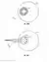 Fig. 26 - Charged particle cancer therapy dose distribution method and apparatus