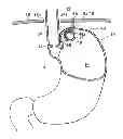 Fig. 01 - Methods and instruments for treating GERD and haital hernia