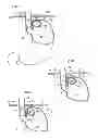 Fig. 02 - Methods and instruments for treating GERD and haital hernia