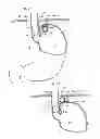 Fig. 04 - Methods and instruments for treating GERD and haital hernia