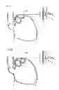 Fig. 06 - Methods and instruments for treating GERD and haital hernia