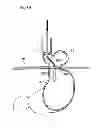Fig. 22 - Methods and instruments for treating GERD and haital hernia