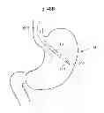 Fig. 28 - Methods and instruments for treating GERD and haital hernia