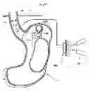 Fig. 33 - Methods and instruments for treating GERD and haital hernia