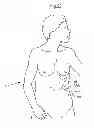 Fig. 37 - Methods and instruments for treating GERD and haital hernia