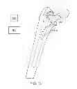 Fig. 10 - Use of micro- and miniature position sensing devices for use in TKA and THA