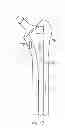 Fig. 16 - Use of micro- and miniature position sensing devices for use in TKA and THA