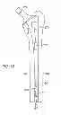 Fig. 17 - Use of micro- and miniature position sensing devices for use in TKA and THA