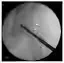 Fig. 01 - Cannulated screw probe