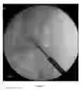 Fig. 04 - Cannulated screw probe