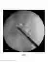 Fig. 05 - Cannulated screw probe
