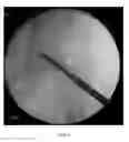 Fig. 07 - Cannulated screw probe