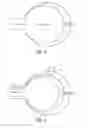 Fig. 07 - METHOD AND SYSTEM FOR TREATING CARDIOVASCULAR DISEASE
