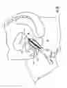 Fig. 23 - Urinary incontinence device and method and stimulation device and method