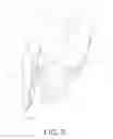 Fig. 10 - Modular shoulder external rotation wedge system and method