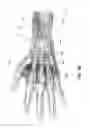 Fig. 17 - Orthopedic Cast and Method to Manufacture Same