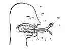 Fig. 16 - Device and method for cooling a patient