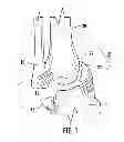 Fig. 02 - Combination holder/impactor and bone plate for fracture fixation